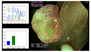 図２　大腸内視鏡検査における病変領域検出と分類を行う全画面診断支援システム